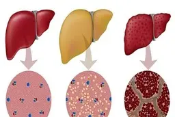 7مشکلی که نشانه بیماری کبدی هستند