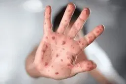 210 مبتلای آبله میمونی | تعداد فوت شدگان آبله میمونی در جهان 