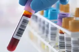 پیش بینی مبتلا شدن یا نشدن به آلزایمر فقط با انجام این آزمایش خون!