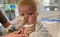 نوزاد آمریکایی با اولین پیوند قلب و تیموس در تاریخ پزشکی ماندگار شد