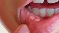 آفت دهان یک بیماری محسوب می شود؟ | آفت دهان و راه های درمان آن چیست؟
