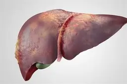 رژیم غذایی مناسب برای درمان کبد چرب