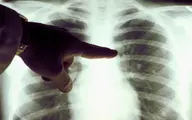 تشخیص سرطان ریه با استفاده از هوش مصنوعی