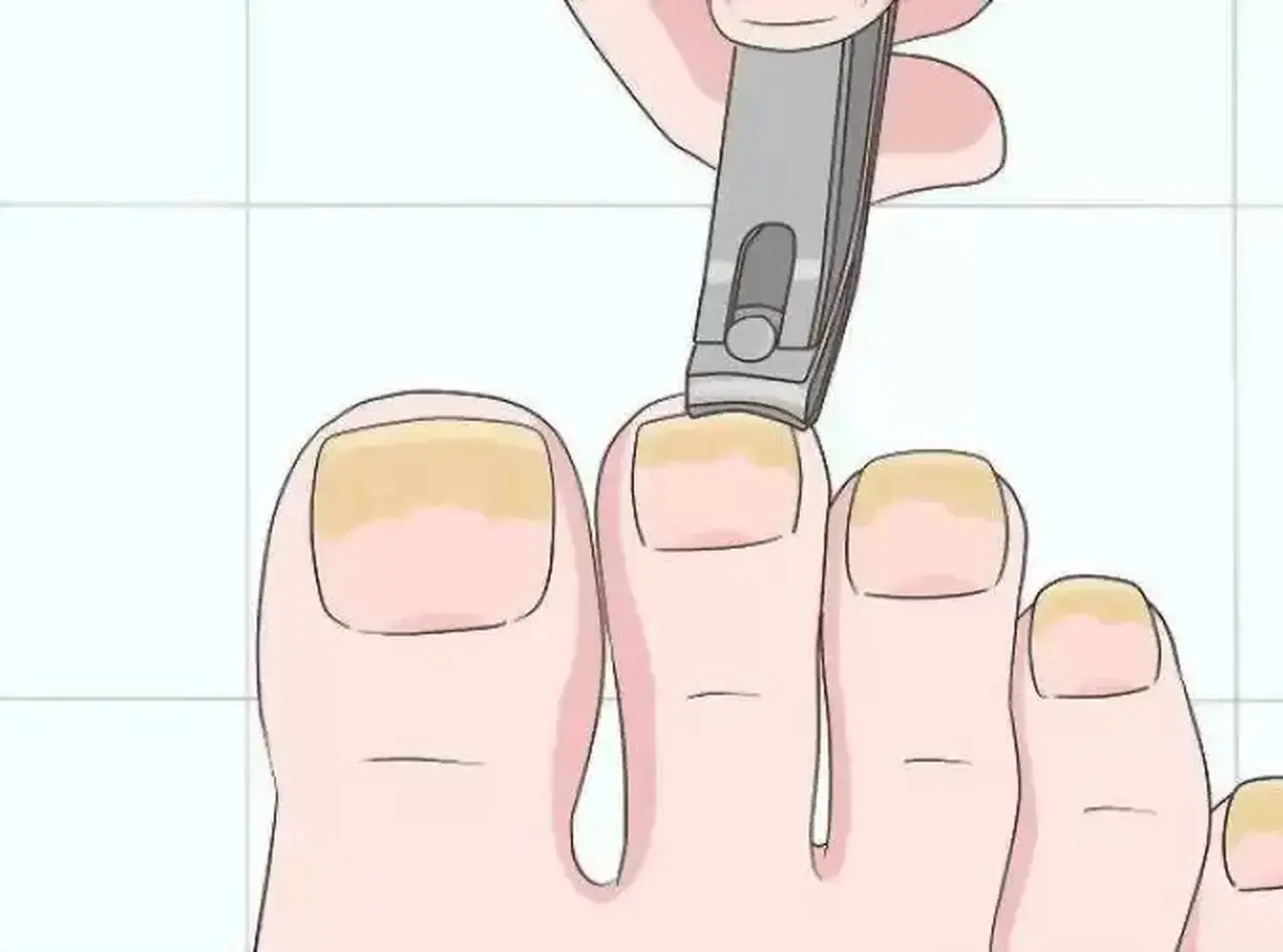 بهترین راهکار برای درمان قارچ ناخن پا | با این روش قارچ‌ناخن پا را از بین ببرید