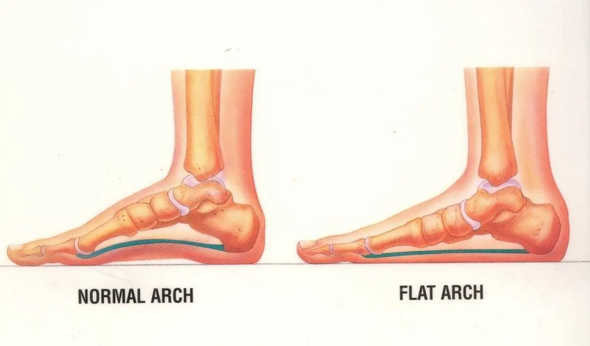 قسمت خارجی پاهایتان درد می‌کند؟ ممکن است به این بیماری‌ها مبتلا شده باشید 