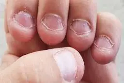آیا ناخن جویدن نگران کننده است؟ 