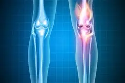 پیشگیری از آرتروز با یک هیدروژل تزریقی جدید