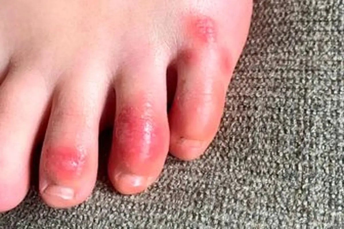 آیا انگشت پای کوویدی مرتبط با کرونا است؟ 