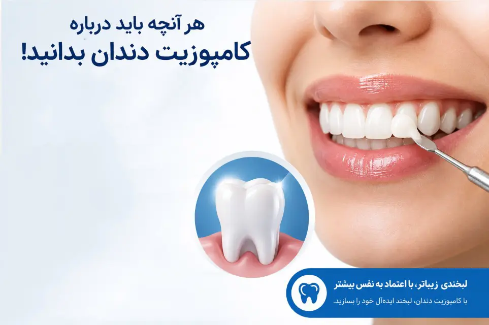 سوالات متداول کامپوزیت دندان