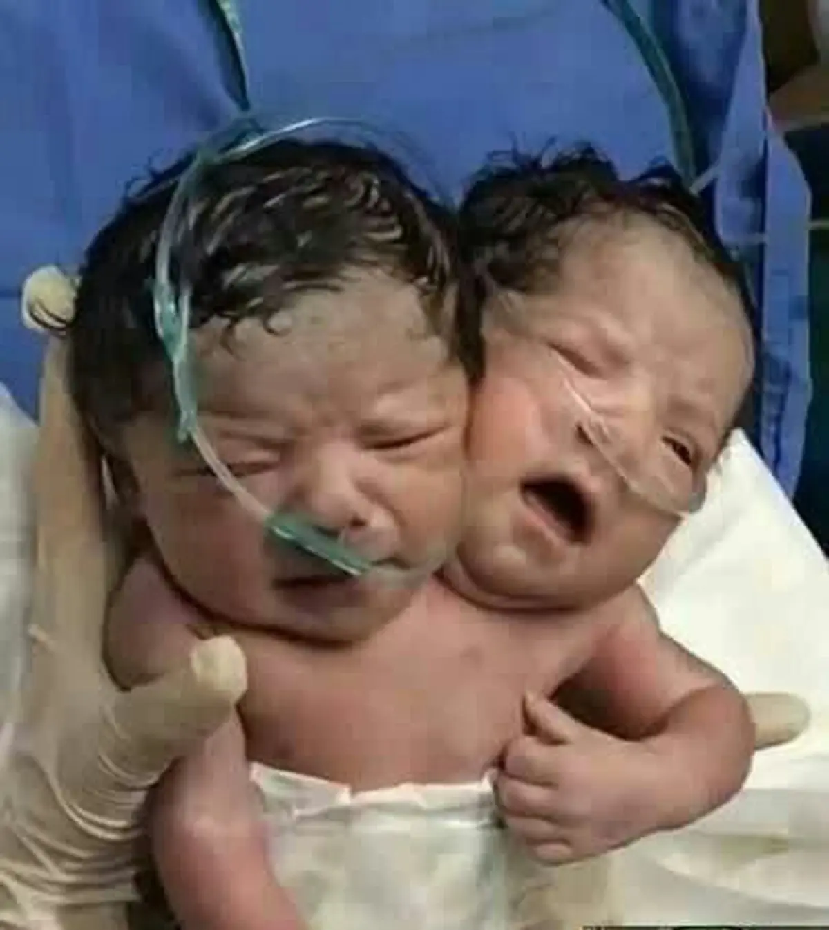 تصویر عجیب از متولد شدن یک نوزاد با دو سر در یک بدن! 