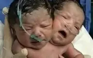 تصویر عجیب از متولد شدن یک نوزاد با دو سر در یک بدن! 