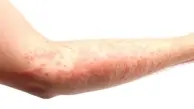  نشانه‌های پوستی ابتلا به اومیکرون چیست؟