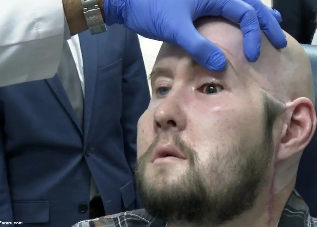 نخستین پیوند چشم کامل در انسان انجام شد! | یک تیم جراحی در نیویورک این موفقیت را کسب کرد 