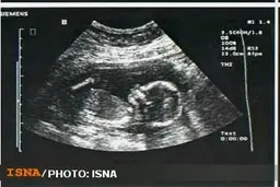 کمبود سونوگرافی در دامغان| پزشکان رغبتی برای ماندن ندارند