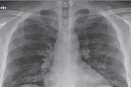 ویدئوی عجیبی از ریه بیمار مبتلا به اومیکرون!