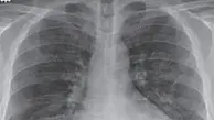 ویدئوی عجیبی از ریه بیمار مبتلا به اومیکرون!