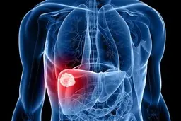 یک مطالعه: ابتلا به سرطان کبد تا سال ۲۰۵۰ در سراسر جهان دو برابر خواهد شد