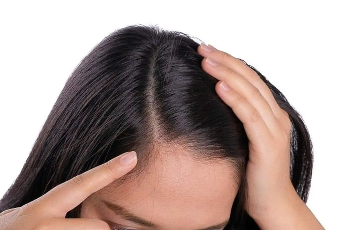 افزایش خطر ریزش مو پس از کرونا |  چرا پس از کرونا دچار ریزش مو می شویم؟ 
