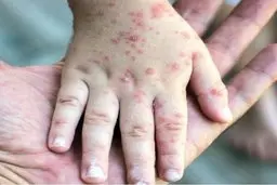 سرخک دوباره برگشت؟ | موارد ابتلاء در هرمزگان و یزد گزارش شد