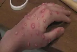 سوغاتی بد برای بوشهری ها | آبله میمونی در ایران | همین را کم داشتیم ! | کرونا ، گرد و خاک و ریزش ساختمان، یک طرف حالا آبله میمونی