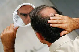
ریزش مویکی ازنشانه های نادر کووید 19 
