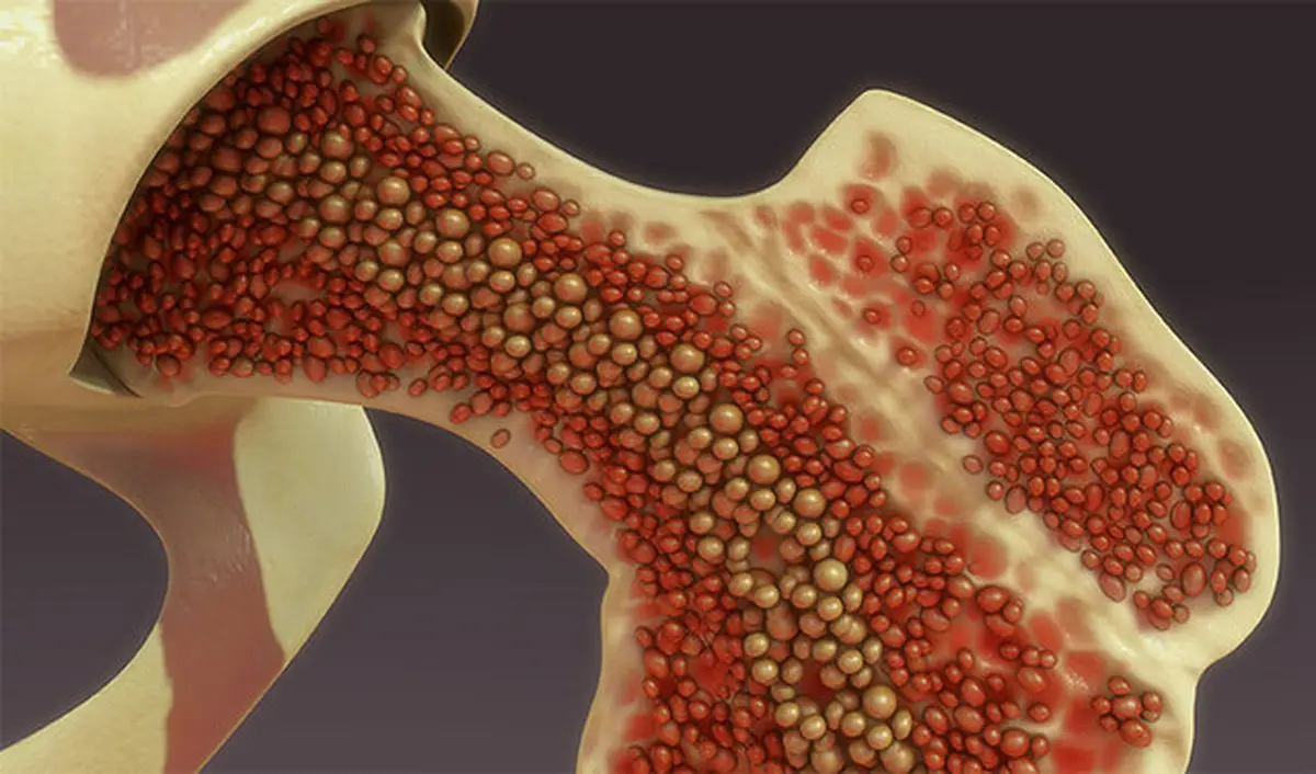نتایج امیدوارکننده‌ یک روش جدید برای درمان سرطان مغز استخوان
