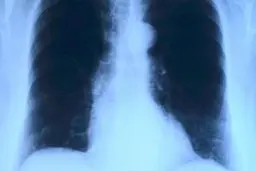 آمبولی ریوی چیست و چه علائمی دارد؟ 