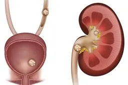 اگر این خوراکی ها را بخورید، سنگ کلیه می گیرید 