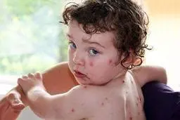 پاندمی جدید در راه است | آنفولانزای گوجه فرنگی چیست؟