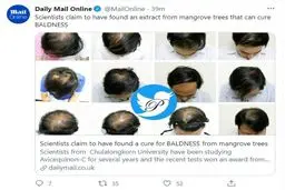 درمان باورنکردنی طاسی +عکس 