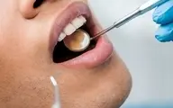 کرونا به دندان‌ها هم آسیب می زند | دندانپزشکی‌های تعطیل هم به سلامت دندان‌ها آسیب رساندند