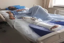  مردم  و فعالان نگران قطع پای محیط بان خوزستانی هستند
