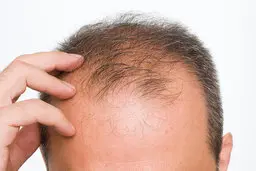 صنعت چند میلیارد دلاری درمان ریزش مو