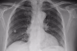 هرگز نزدیک فردی که بیماری سل ریوی دارد، نشوید | بیماری سل به راحتی به 15 فرد سالم انتقال می یابد