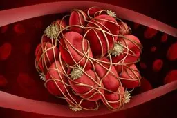 لخته‌ خون؛ از نشانه تا عوارض