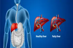 یک رژیم غذایی تعجب‌آور برای مبارزه با کبد چرب!
