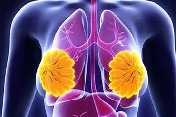 افزایش ابتلا به سرطان سینه در ایران | هشدار درباره سبک زندگی و سن جوانی