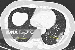 تشخیص کروناویروس ۴ روز زودتر امکان‌پذیر شد
