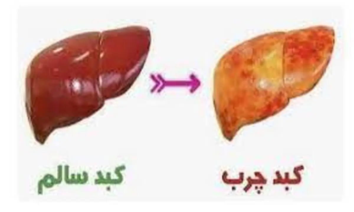 درمان فوری کبد چرب با مصرف چند میوه معجزه گر