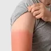 چگونه در خیابان دچار آفتاب‌سوختگی نشویم؟ | توصیه‌های طلایی متخصص پوست برای روزهای داغ تابستان
