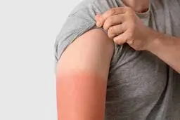چگونه در خیابان دچار آفتاب‌سوختگی نشویم؟ | توصیه‌های طلایی متخصص پوست برای روزهای داغ تابستان