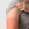آفتاب‌سوختگی را با این توصیه‌ها از خود دور کنید | راهکارهای ساده برای روزهای گرم