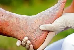 کشف تکنیک جدیدی برای درمان واریس