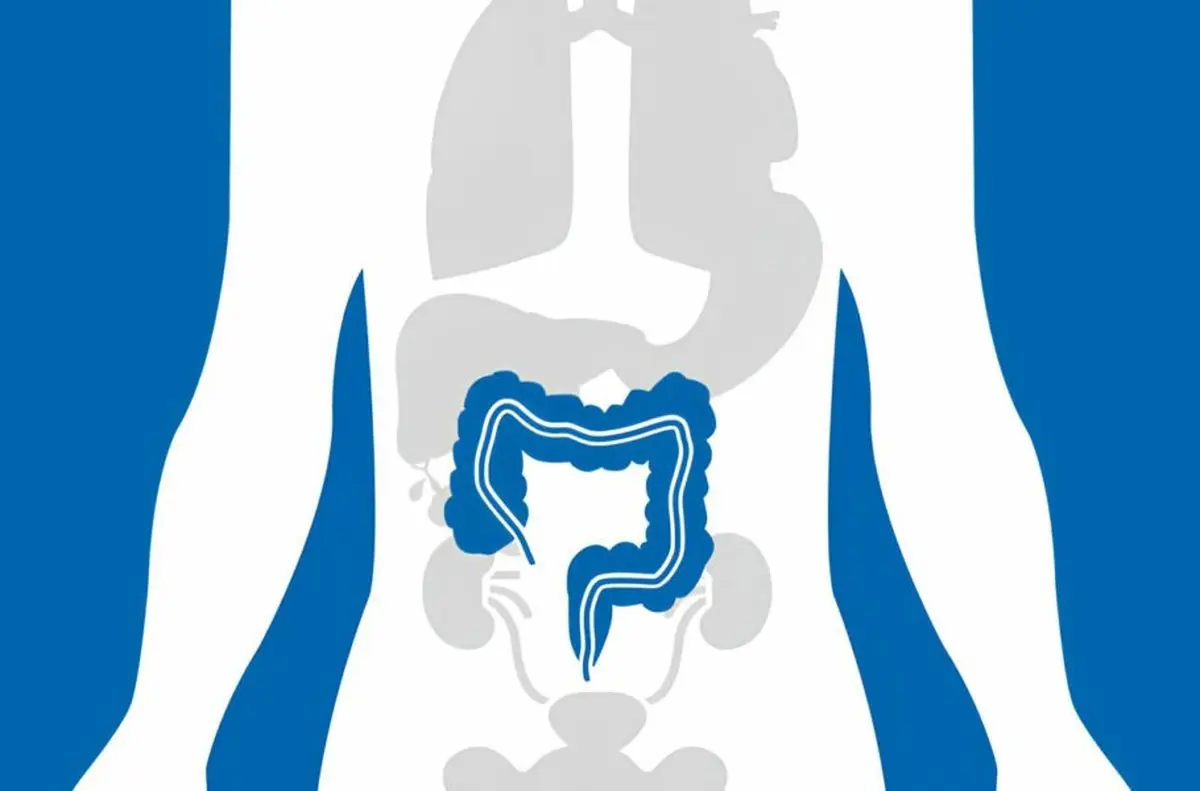 محققان: باکتری عامل پلاک دندان شاید با ابتلا به سرطان روده بزرگ ارتباط داشته باشد