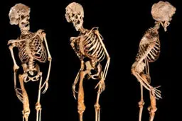 وحشتناک‌ترین بیماری دنیا که درمانی هم ندارد | معرفی بیماری سندرم مرد سنگی +ویدئو