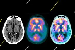 دارویی علیه فراموشی! ماجرای داروی جدید آلزایمر چیست؟