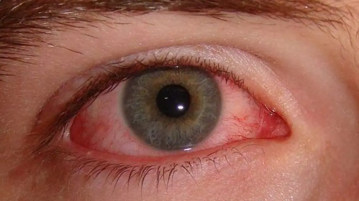 کرونا|قرمزی چشم،  یک علامت مهم در ابتلا به کرونا
