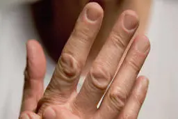 درمان روماتیسم  باطب سنتی 