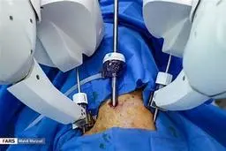 انقلابی در جراحی؛ جراح چینی توموری را از راه دور با ربات برداشت | جراحی از راه دور با فاصله ۵ کیلومتری +ویدئو