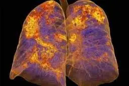 چرا کرونا شدیدترین آسیب را به ریه وارد میکند؟